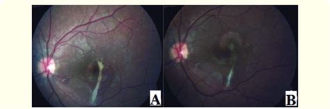 Color macula images of the left eye at the first presentation (A)and at ...