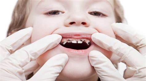 Treatment Options When Your Child Has Severe Tooth Decay