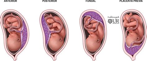 Placental positions. Illustration of different placental positions. The... | Download Scientific ...