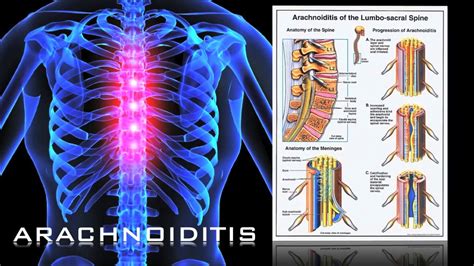 Epidural Steroid Injections & Arachnoiditis / FDA-PROP HEARING - YouTube