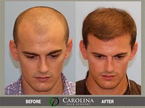 26 Year Old Male With Norwood Class 4 Hair Loss - Carolina Hair Surgery