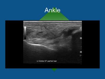 Musculoskeletal Ultrasound | Southern California Orthopedic Institute