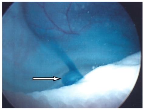 Intraoperative cystoscopic image of the left ureteral orifice after the... | Download Scientific ...