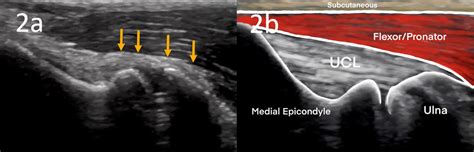 The Use of MSK Ultrasound in the Evaluation of Elbow Ulnar Collateral ...