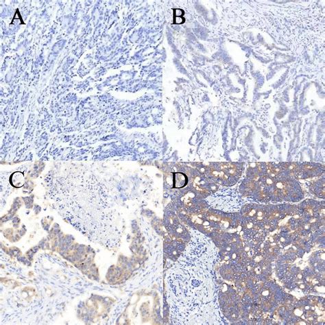 Immunohistochemical staining for BRAF V600E in colorectal cancer. (A-D ...