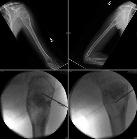 Evidence-Based Treatment of Simple Bone Cyst | Musculoskeletal Key