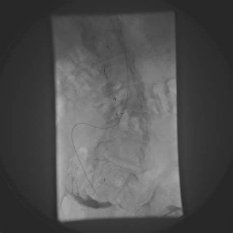 Shuntogram via the functioning shunt shows normal peritoneal drainage... | Download Scientific ...