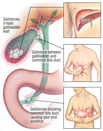 Bile Duct Diseases - Harvard Health