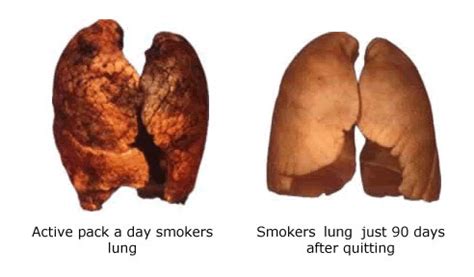 Lungs Before and After Quitting Smoking