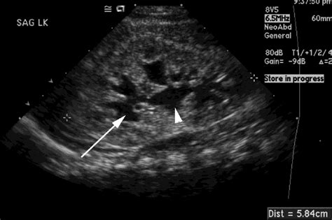 Kidney Ultrasound