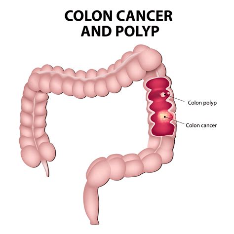 Colorectal Polyps in Singapore - Alpha Digestive & Liver Centre