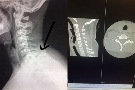 Q & A: Spinous Process Fracture | The Physical Therapy Advisor