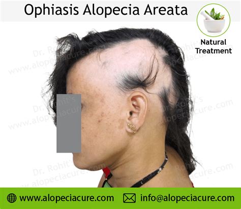 Ophiasis Alopecia Areata