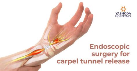 Endoscopic Carpal Tunnel Surgery for Carpal Tunnel Syndrome