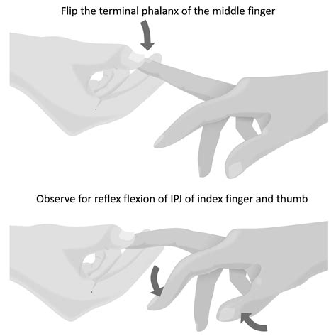 Hoffmann’s Sign | Epomedicine