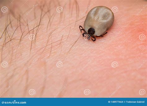 The tick on human skin stock photo. Image of lyme, disease - 148977664