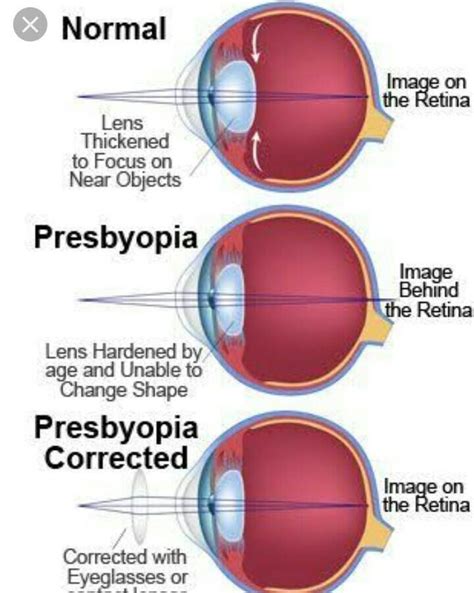 Lenses Correct Vision By Brainly - List two causes of presbyopia. Draw a labelled diagram of ...