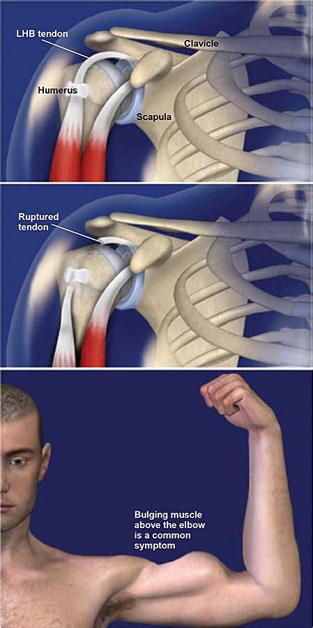 Biceps Tendon Rupture | Central Coast Orthopedic Medical Group