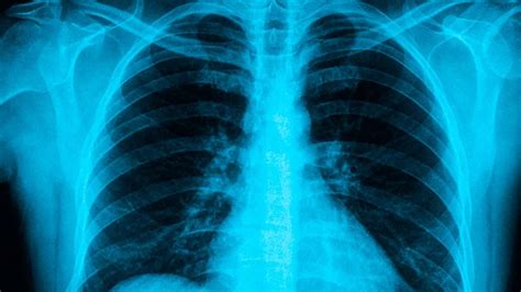 Healthy Lungs Vs Smokers Lungs X Ray