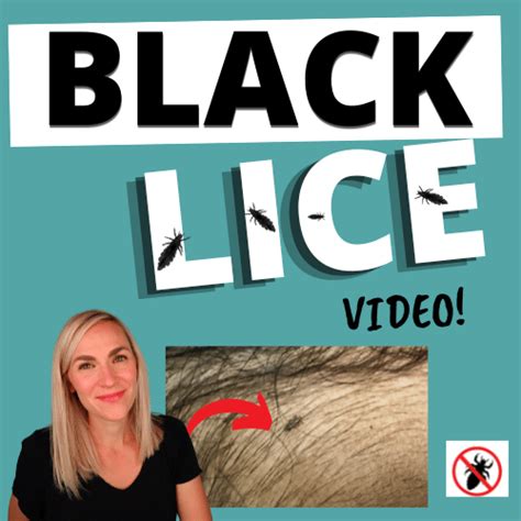 Black Lice - Video! - My Lice Advice