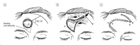 Double-Opposing Rotation-Advancement Flaps for Closure of Forehead ...