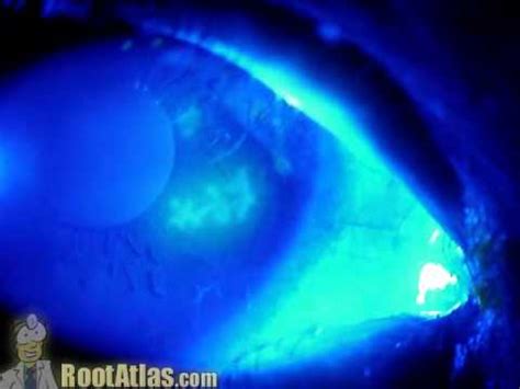 Dendritic corneal ulcer - YouTube