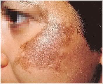 Skin Hyperpigmentation Causes & Treatments (+Pics!)