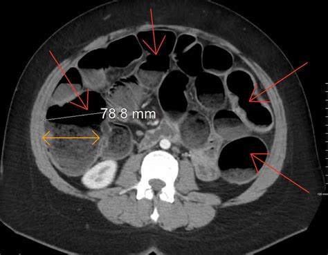 Cureus | Acute Large Bowel Obstruction Caused by Endometriosis Requiring Sigmoidectomy