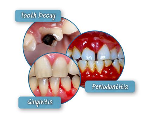 How To Clean Plaque Off Teeth Without Dentist - How To Use One Correctly Which Model To Buy And ...