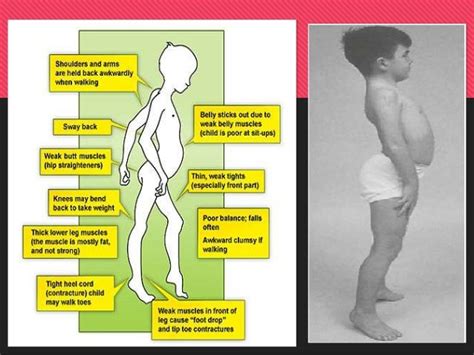 Dystrofia Beckera Objawy I Przyczyny