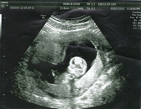 It's A Cardall Thing...: My 3 Month Ultrasound