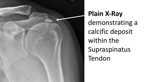 Shoulder Calcification