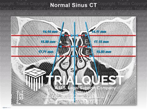 Normal Sinus CT - TrialExhibits Inc.