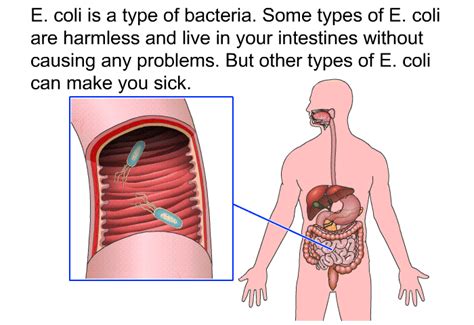 PatEdu.com : E. coli Infections