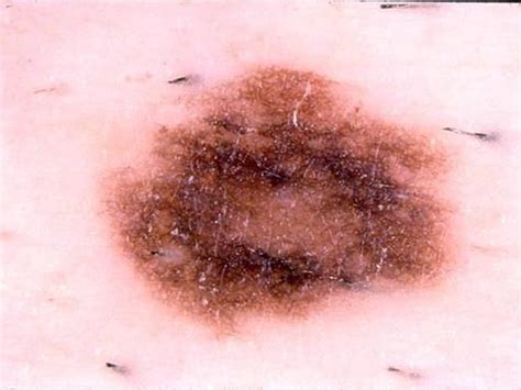 Dysplastic nevus - Skin cancer or mole? How to tell - Pictures - CBS News