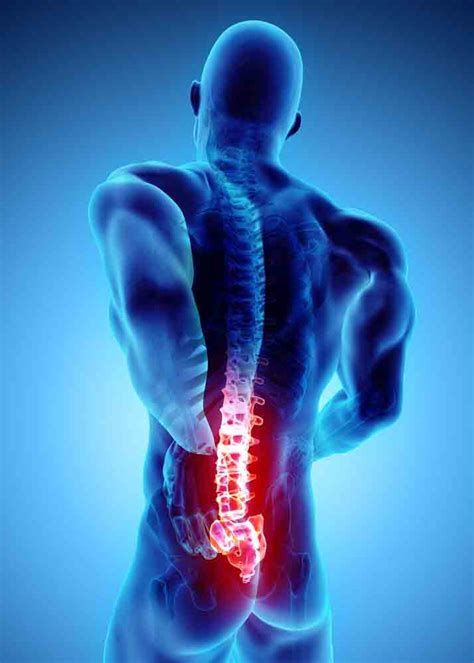 Lumbar Radiculopathy - SOL Physical Therapy