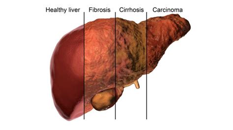 Fatty Liver Disease Program | Los Angeles - Southern California Multi ...