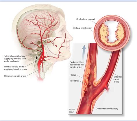 Figure 1 from Carotid artery disease: stenting vs endarterectomy ...