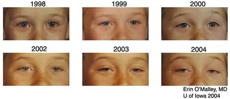 EyeRounds.org: Chronic Progressive External Ophthalmoplegia - Kearns-Sayre Syndrome