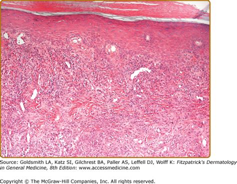 Erythema Elevatum Diutinum | Plastic Surgery Key