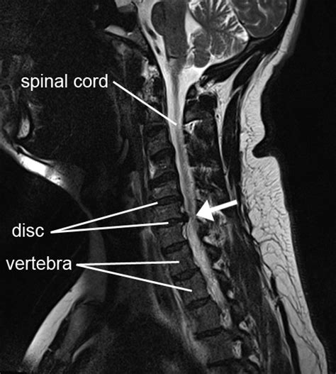 Cervical radiculopathy | Physio Check