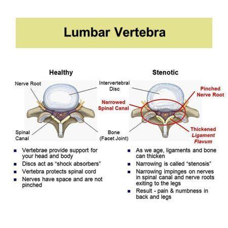 Ligamentum Flavum Hypertrophy | Spinal canal, Treatment, Spine surgery