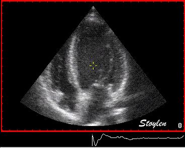 Echocardiography GIF - Conseguir el mejor gif en GIFER