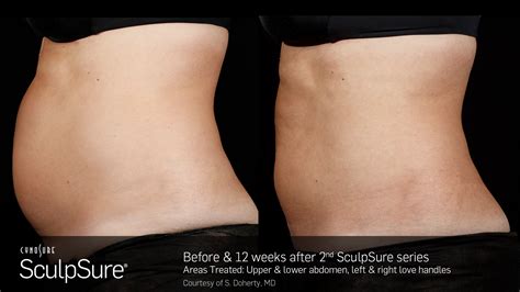 WarmSculpting™ with SculpSure® Body Contouring in Whittier, CA