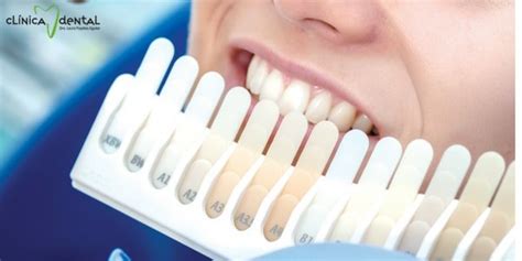 ¿Quieres hacerte un blanqueamiento dental casero? Primero infórmate bien