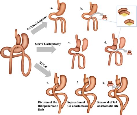 Roux En Y Gastric Bypass Steps