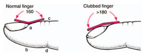 Episode 1: Why does fingernail clubbing occur in so many different ...