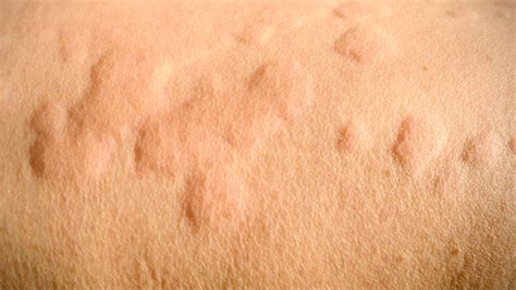 Urticaria (Hives) - Dermatology & Co : Dermatology & Co