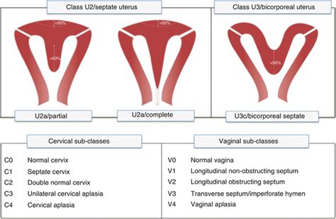 Uterine Septum | SpringerLink