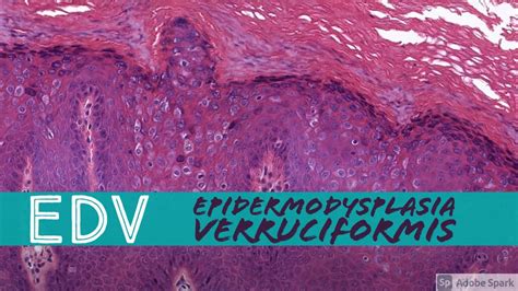 Epidermodysplasia Verruciformis Workup Laboratory Studies